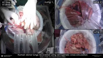 Testul uimitor prin care cercetătorii au adus la viață plămâni distruși, care nu mai puteau fi transplantați. VIDEO