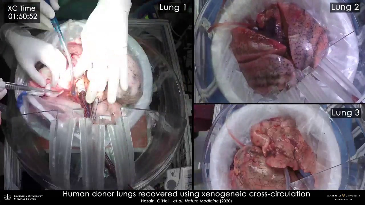 Testul uimitor prin care cercetătorii au adus la viață plămâni distruși, care nu mai puteau fi transplantați. VIDEO