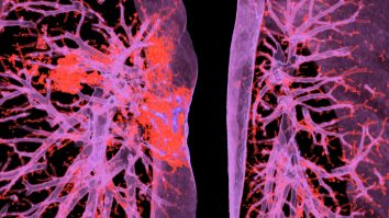 FDA a aprobat primul vaccin pentru virusul sincițial respirator care poate fi administrat gravidelor. Care sunt cauzele și efectele bolii