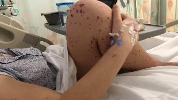 Erupții ale pielii care pot semnala existența coronavirusului. La ce trebuie să fii atent