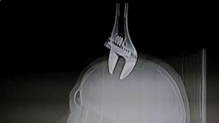 Miracol medical: Un chinez a supraviețuit după ce i s-a înfipt în cap o cheie franceză de 15 centimetri
