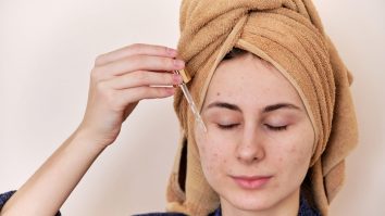 Tu ştii ce e de fapt acneea şi cum o poţi trata?