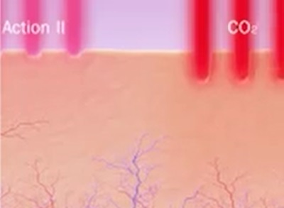 Un nou studiu arată că laserul cu CO2 stimulează funcția sexuală a femeii