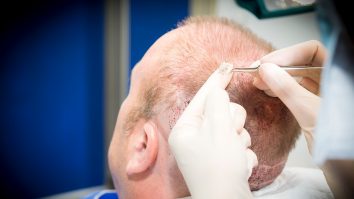 Ce trebuie să știi despre implantul de păr. Dacă este complexă, intervenția poate dura și 16 ore