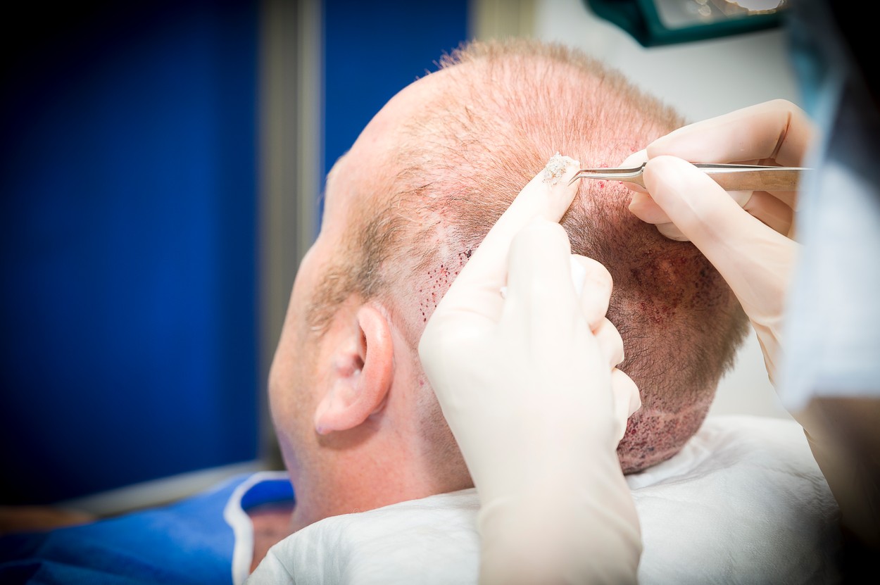 Ce trebuie să știi despre implantul de păr. Dacă este complexă, intervenția poate dura și 16 ore