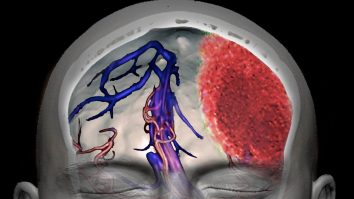 Cum ar putea fi legat sughițul de un accident vascular cerebral sau de cancer – semne și simptome la care trebuie să fii atent