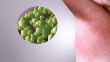 OMS atrage atenţia că pandemia de coronavirus perturbă lupta împotriva rujeolei