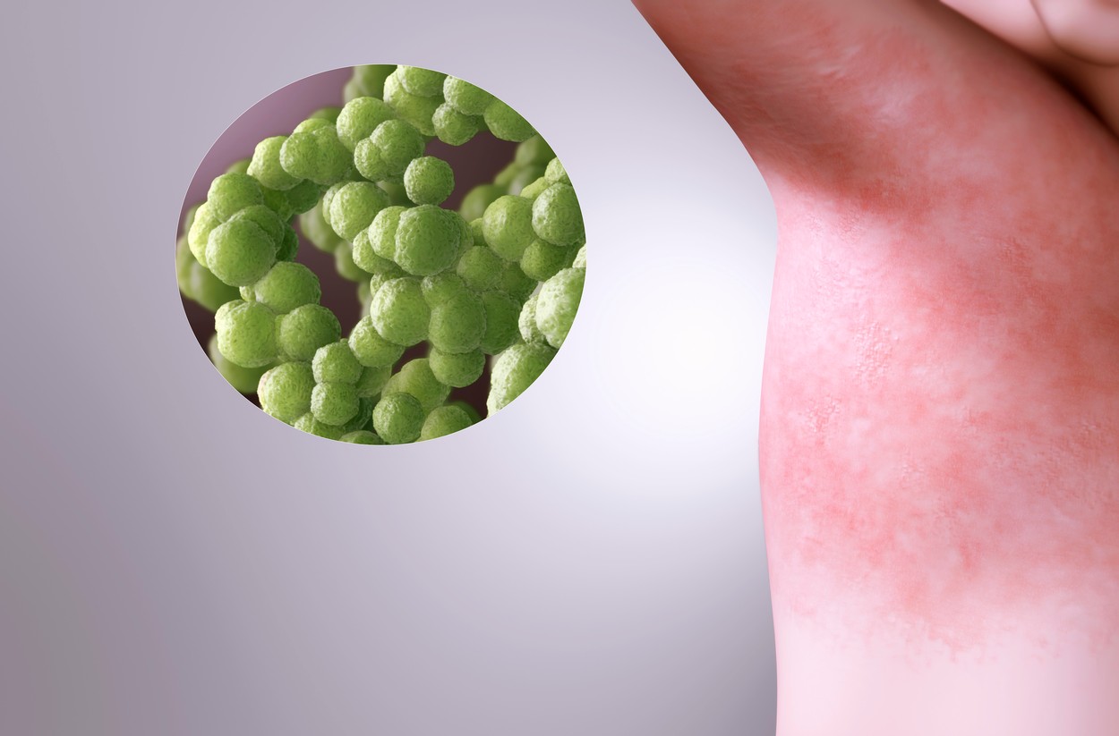 OMS atrage atenţia că pandemia de coronavirus perturbă lupta împotriva rujeolei