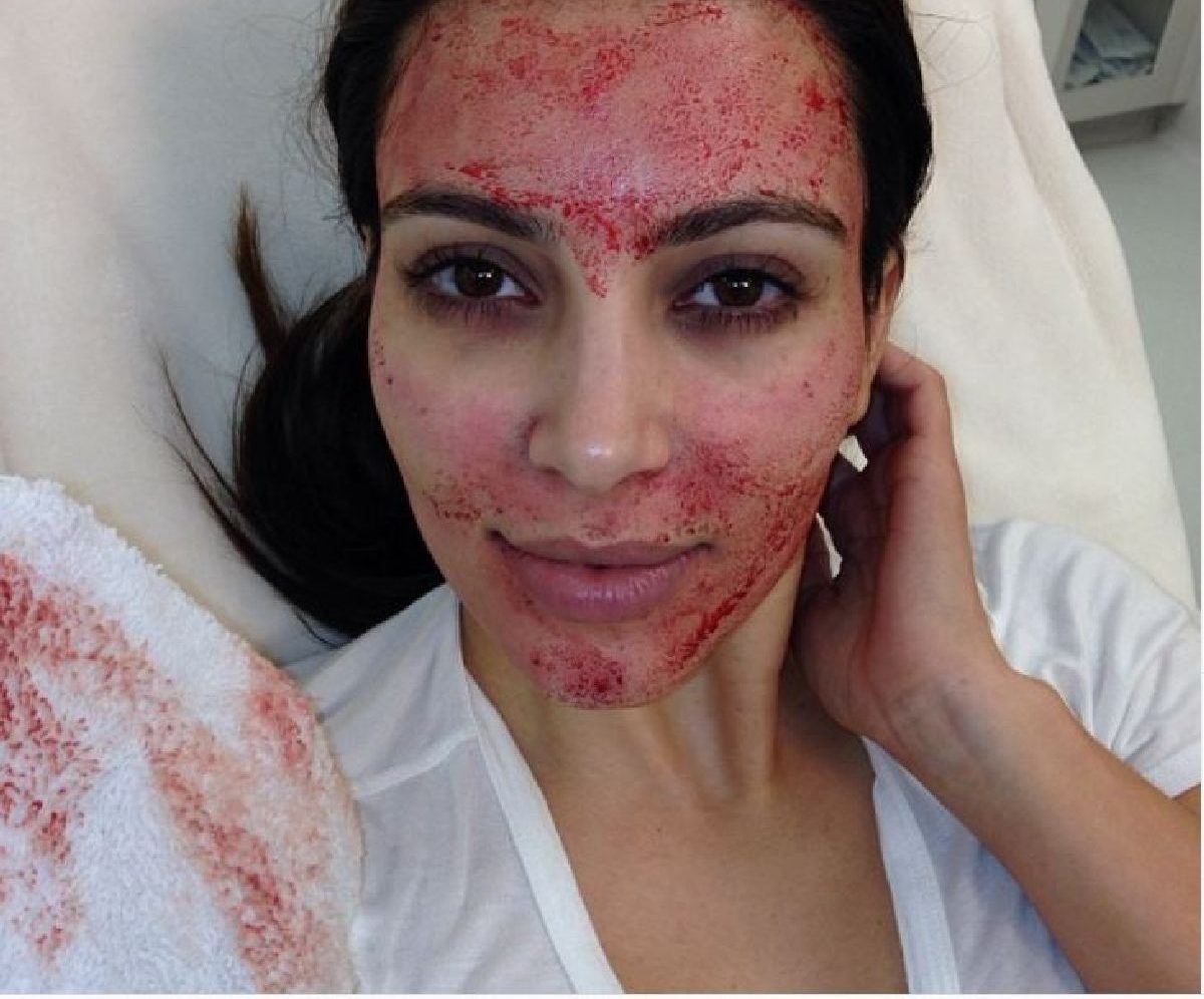 Ce este „Terapia Vampir”? Elimină ridurile, cearcănele și acneea