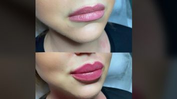 Fals medic estetician, prins de poliție. „Dr. Lana” a mărit ilegal buzele a zeci de tinere. O intervenție costa 200 de euro