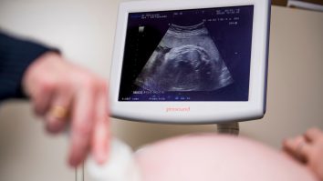 Bebeluș ultrasunete