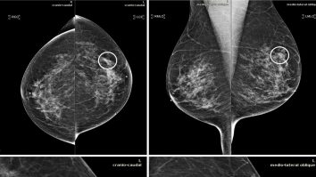 Inteligenţa artificială, folosită pentru tratarea cancerului. Arată ce combinație de medicamente distruge celulele canceroase