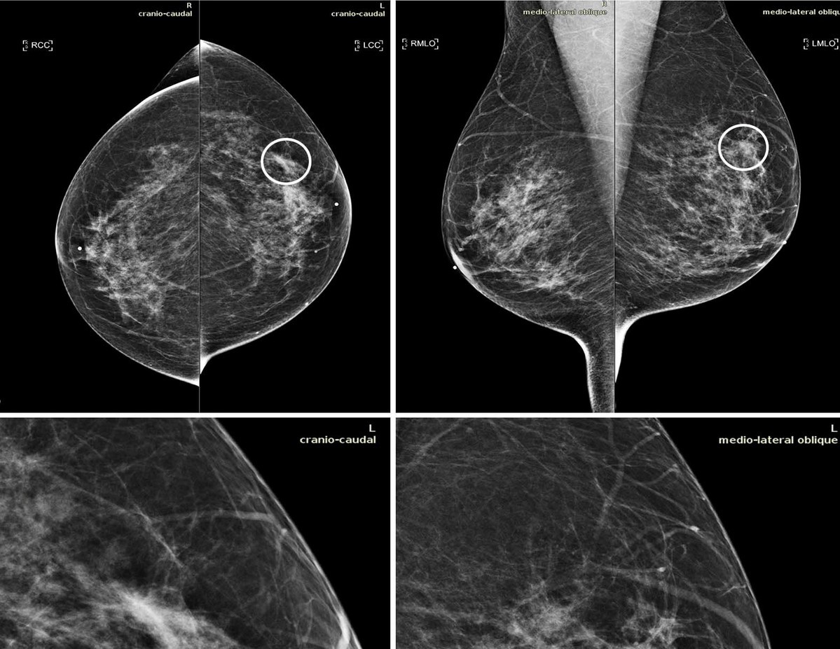 Inteligenţa artificială,  folosită pentru tratarea cancerului. Arată ce combinație de medicamente distruge celulele canceroase