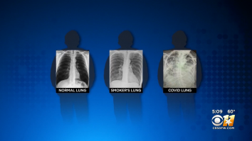 Plămânii post-Covid arată mai rău decât plămânii celor mai înrăiți fumători, spun specialiștii