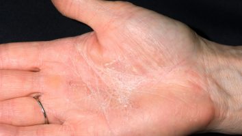 Tot ce trebuie să știi despre dermatită. Dermatolog:  „Poate să existe într-o mulţime de bijuterii, în produse cosmetice, chiar şi în mâncare”