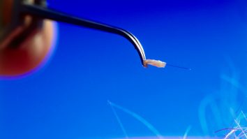 Turismul medical, schimbat de pandemie. Românii nu mai merg în Turcia pentru transplant de păr