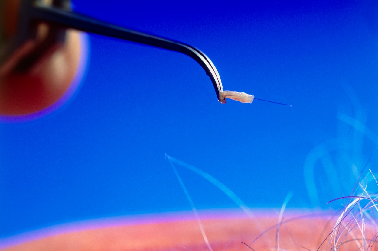 Turismul medical, schimbat de pandemie. Românii nu mai merg în Turcia pentru transplant de păr