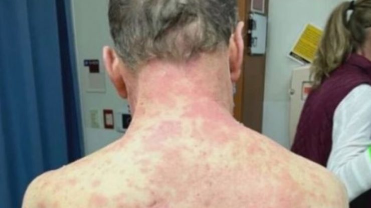 FOTO. Unui bărbat i-a căzut pielea după ce s-a vaccinat cu Johnson&Johnson: s-a înroşit și a crăpat