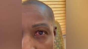 O femeie și-a turnat lipici în ochi, în loc de picături. Iată ce a împiedicat-o să-și piardă vederea