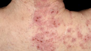 FOTO. O nouă posibilă reacție adversă la vaccinul anti-COVID Pfizer, descoperită în Israel: pacienții au dezvoltat o erupție roșie dureroasă