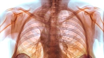 Sâni măriți cu silicon industrial. Mii de femei vor primi despăgubiri. Medic chirurg: „Implantul era pur şi simplu descompus”