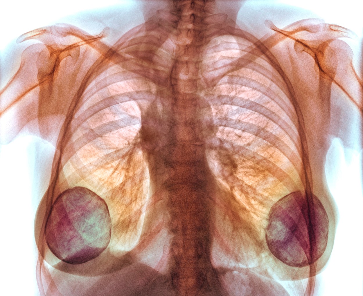 Sâni măriți cu silicon industrial. Mii de femei vor primi despăgubiri. Medic chirurg: „Implantul era pur şi simplu descompus”