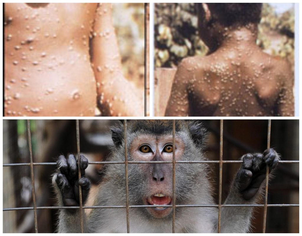 cazuri de variola maimutei