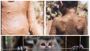 cazuri de variola maimutei