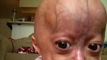 Adalia Rose, fetița comparată cu personajul „Benjamin Button”, a murit la 15 ani