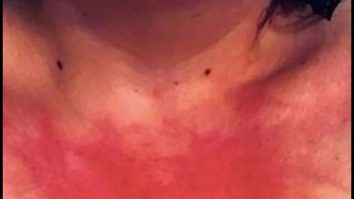 „Alergia” la apă, o boală rară pentru care nu există tratament