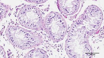 Cancerul ar putea dispărea prin eliminarea „deşeurilor” celulare