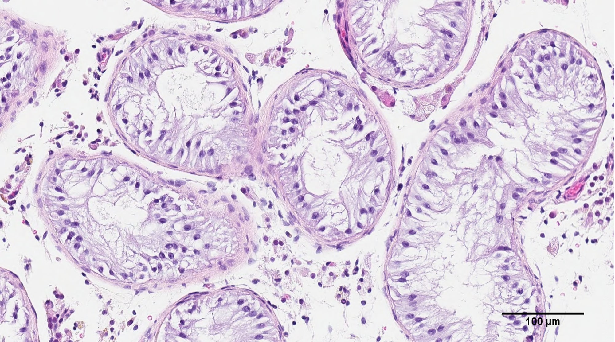 Cancerul ar putea dispărea prin eliminarea „deşeurilor” celulare