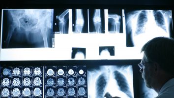 Oamenii de știință repară cu succes oasele prin combinarea terapiei genice și a bioimprimării