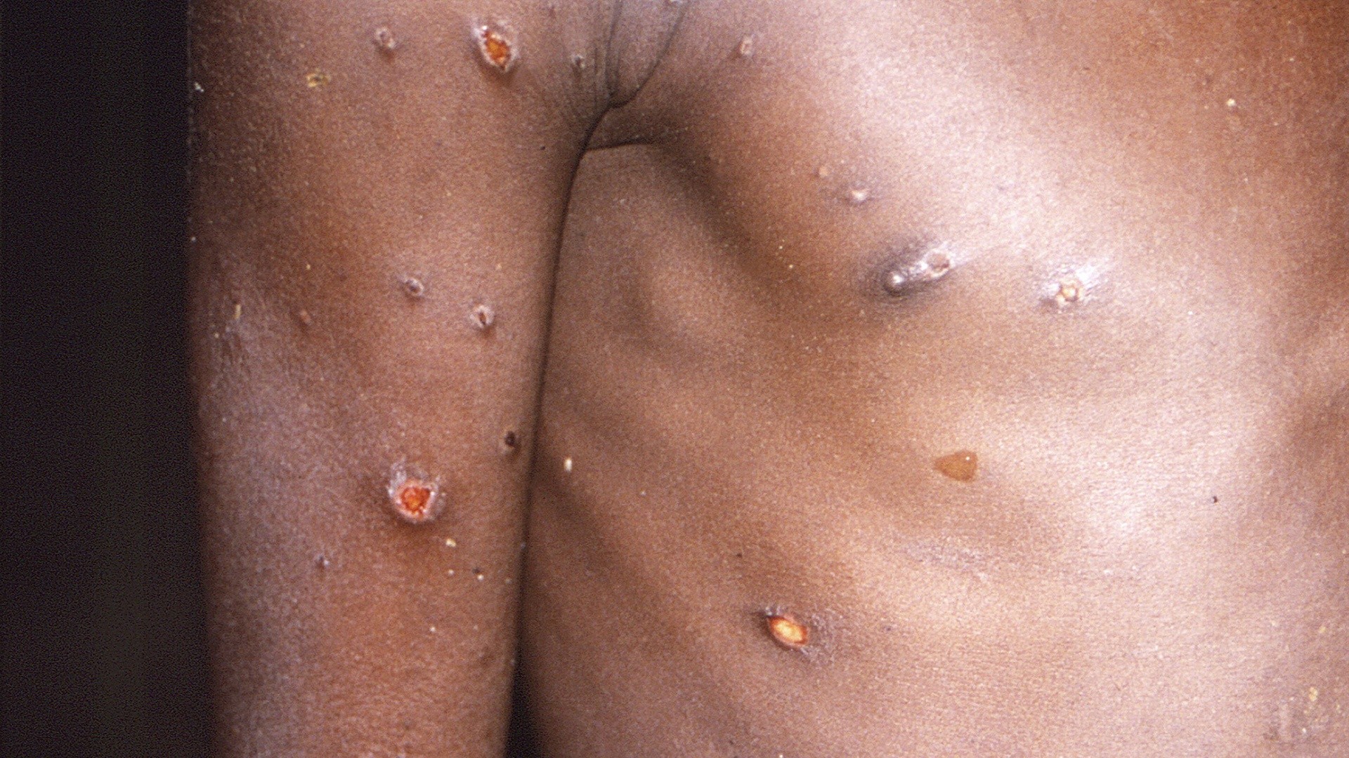 OMS nu consideră epidemia de variola maimuței o urgență de sănătate publică internațională