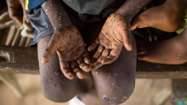 Monkeypox