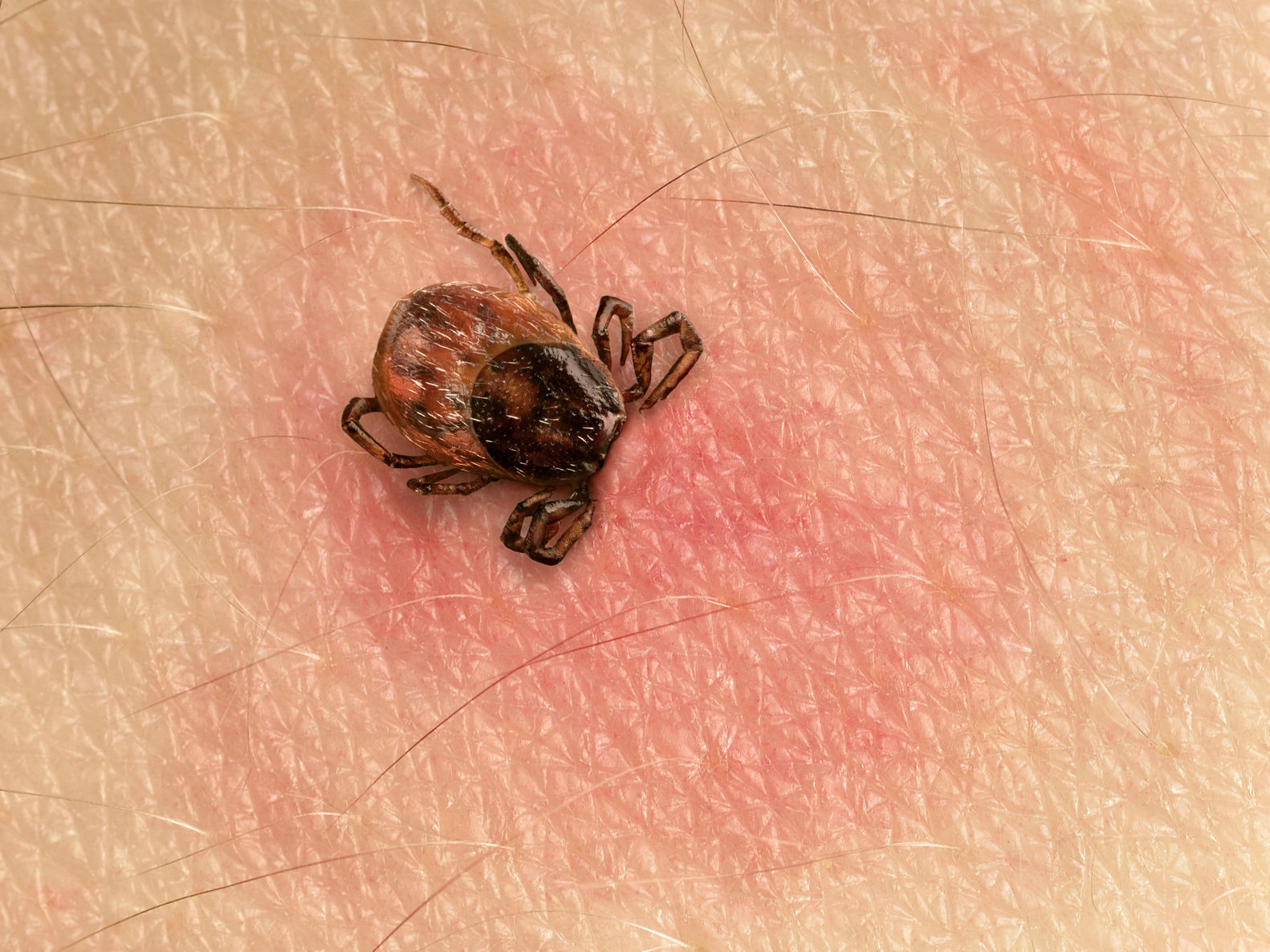 STUDIU. Peste 14% din populația lumii a avut boala Lyme