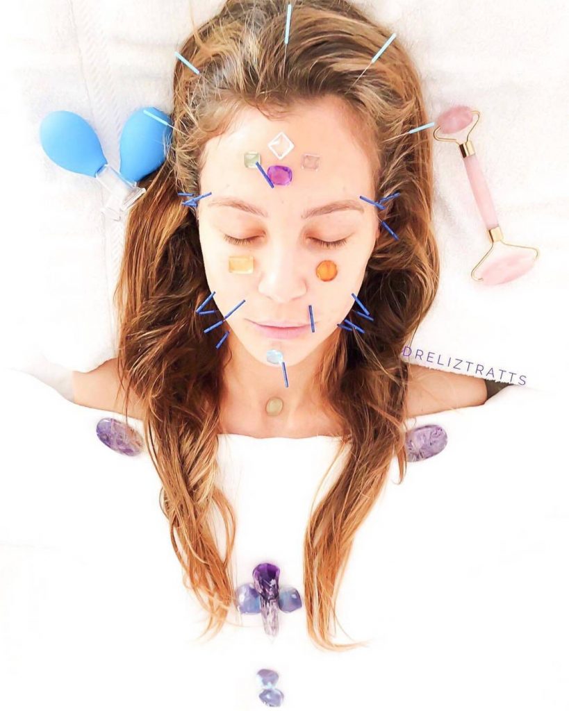Cercetătorii au descoperit că acupunctura ajută la reducerea durerilor de cap