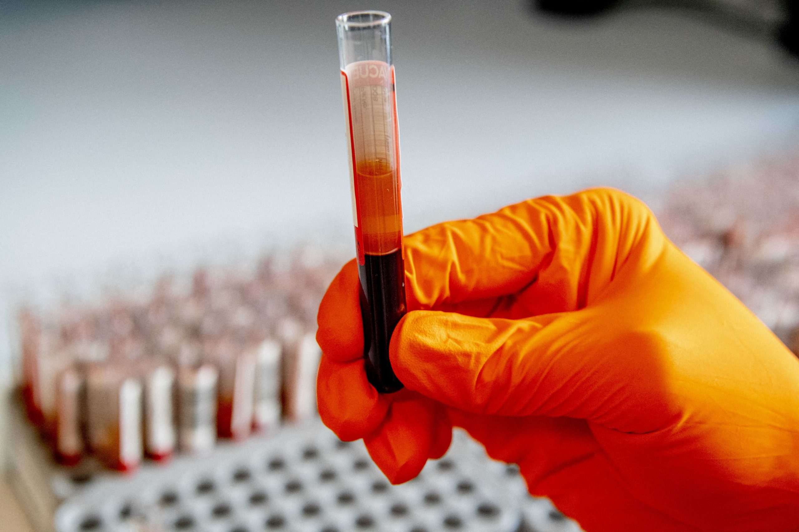 Grupa ta de sânge poate prezice riscul unui accident vascular cerebral precoce, spune o nouă cercetare