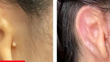 Prima femeie cu transplant de ureche prin tehnologie imprimată 3D