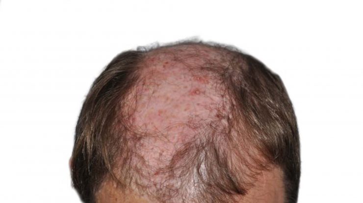 Cercetătorii au descoperit un potențial „remediu” pentru chelie