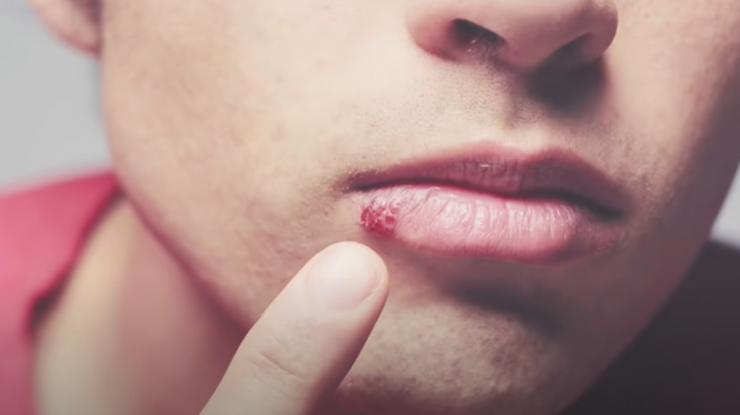 Istoria herpesului: Un virus cu care se confruntau și strămoșii noștri