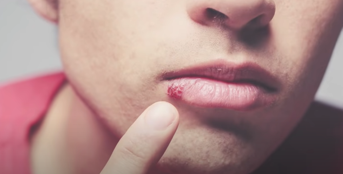 Istoria herpesului: Un virus cu care se confruntau și strămoșii noștri