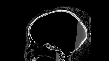 Oamenii de știință chinezi și americani au conceput un instrument de administrare a medicamentelor pentru cancerul cerebral