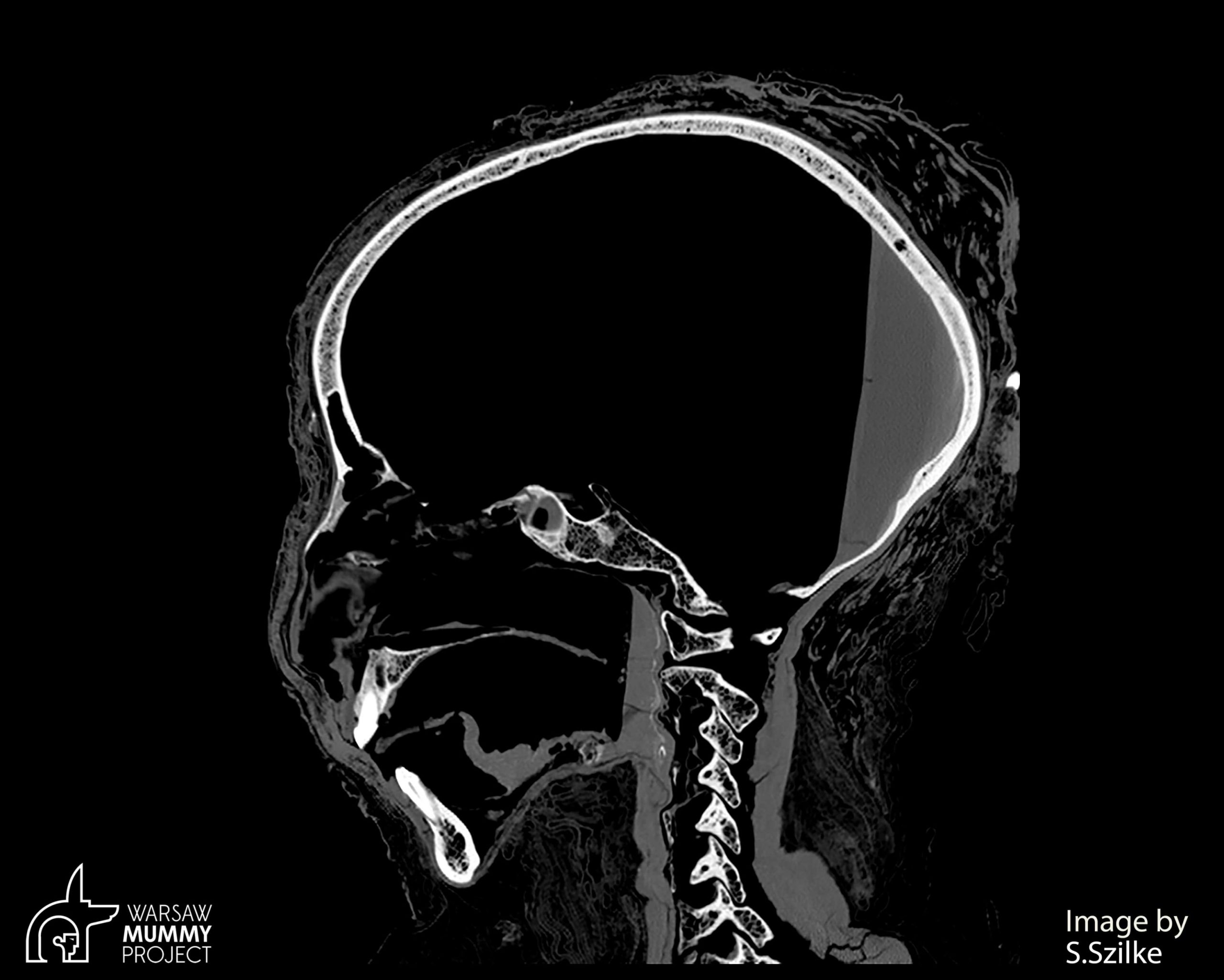Oamenii de știință chinezi și americani au conceput un instrument de administrare a medicamentelor pentru cancerul cerebral