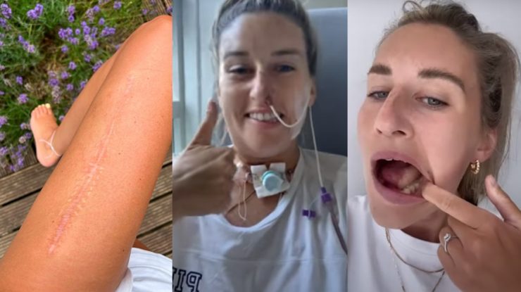 femeie cu cancer bucal