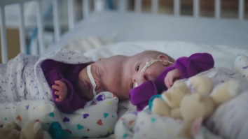 Siamezi uniți în zona craniană, separați cu succes în Brazilia