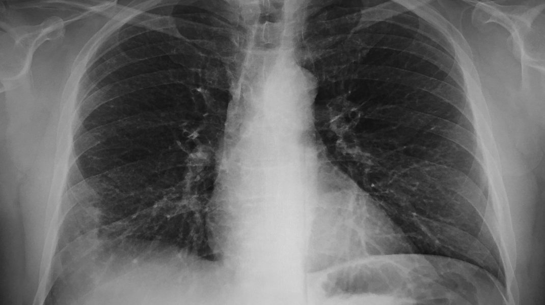 pneumonia
