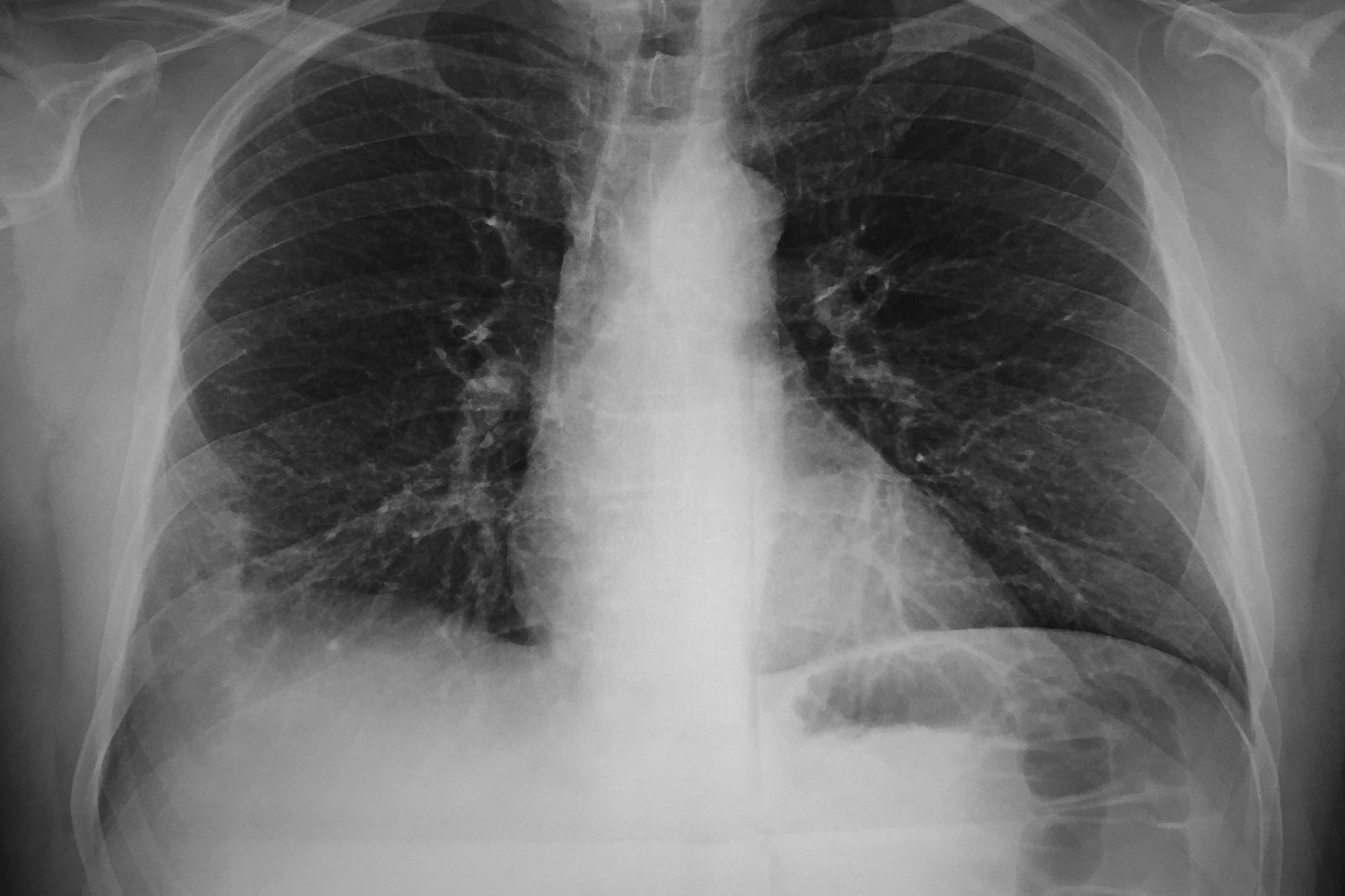 Oamenii de știință au creat nanoroboți pentru a vindeca o formă mortală de pneumonie