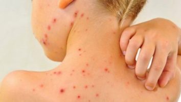 OMS și CDC anunță că rujeola reprezintă acum o amenințare globală iminentă din cauza unei pandemii