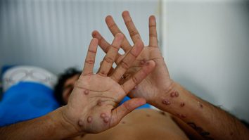 OMS: Variola maimuţei rămâne o urgenţă de sănătate publică